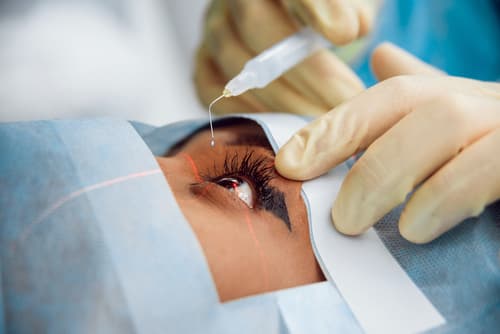 Cataract SURGERY