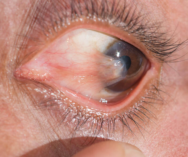 Pterygium Condition