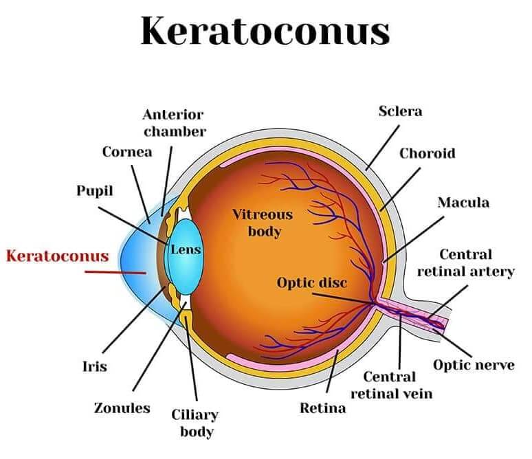 Diagram of a cornea with Keratoconus